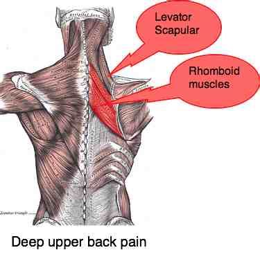 Deep upper back pain can be very difficult to diagnose and manage.