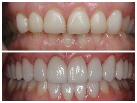 Porcelain Veneers in Glendale | Verdugo Hills Dental Group