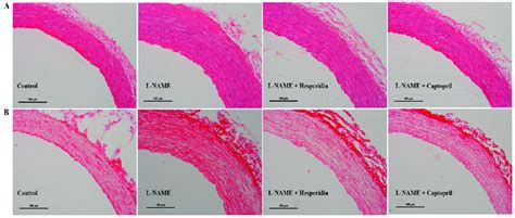 Aortic Dissection Histology