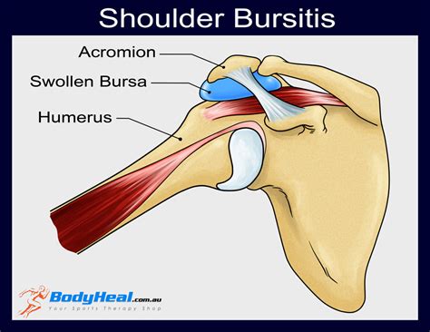 Shoulder Bursa Anatomy - Anatomical Charts & Posters