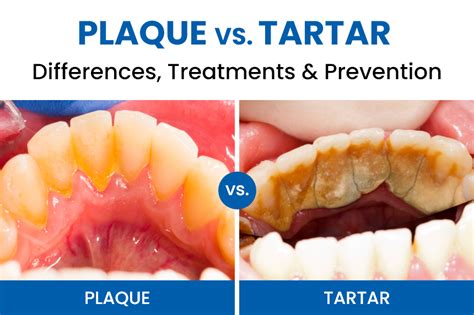 Plaque vs. Tartar: Differences, Treatments & Prevention