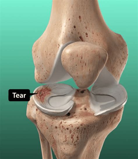 Meniscus Repair | Board Certified Orthopedic Surgeons