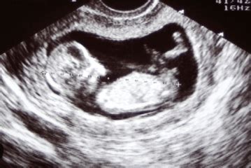 What to Expect During Your 12 Weeks Pregnant UltrasoundIntroduction ...