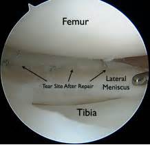 Torn Meniscus Surgery (Video) - Jeffrey H. Berg, M.D.