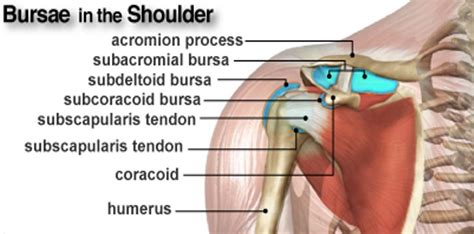 Shoulder Bursitis