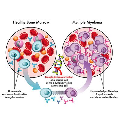 8 Crucial Multiple Myeloma Symptoms to Watch For | Vejthani