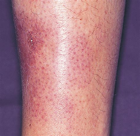 Primary Cutaneous Natural Killer/ T-Cell Lymphoma | Hematology | JAMA ...