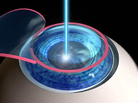 What Are The Different Types of Laser Eye Surgery? | Universal Health Care