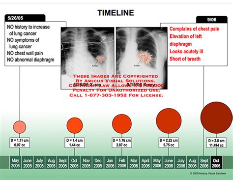 Lung Tumor Size Chart - Best Picture Of Chart Anyimage.Org