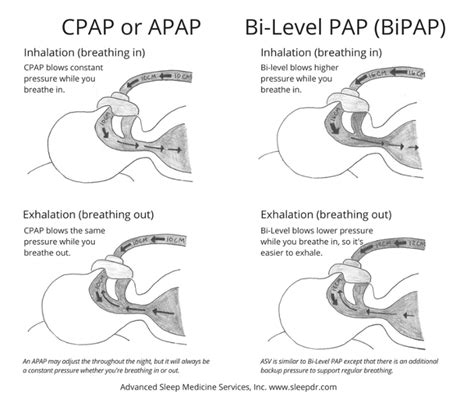 What is a cpap machine difference between cpap apap bipap and asv – Artofit