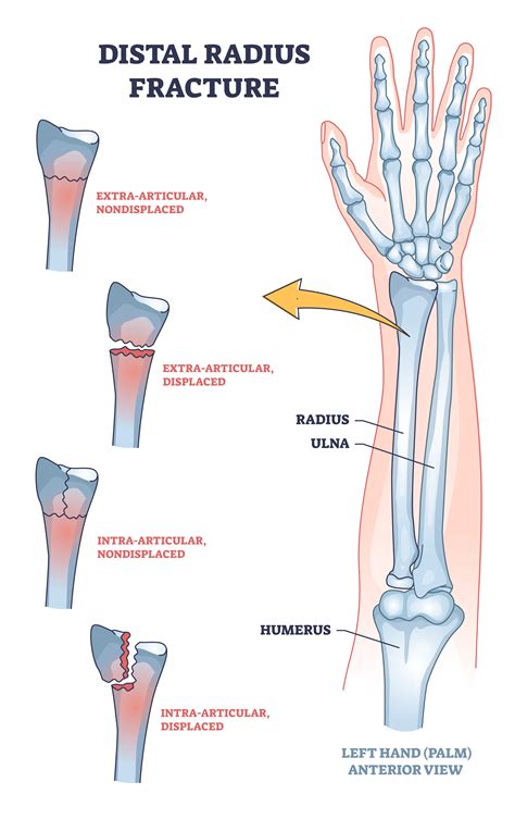 Distal Radius Fracture: What Is It?