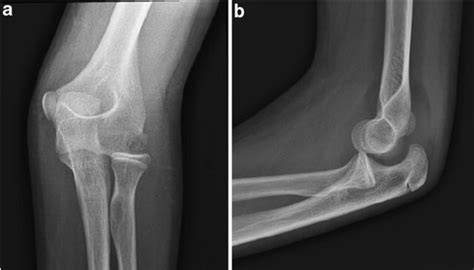 ELBOW DISLOCATION WITH RADIAL HEAD FRACTURE | buyxraysonline