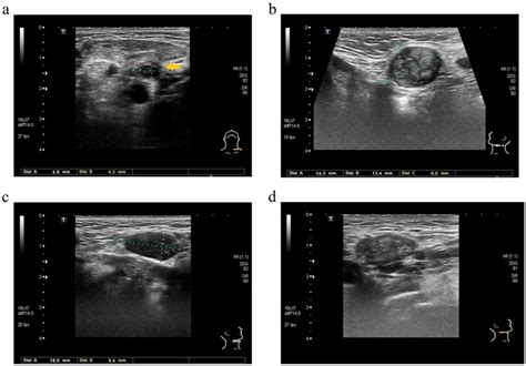 Cancer Neck Lymph Nodes Ultrasound