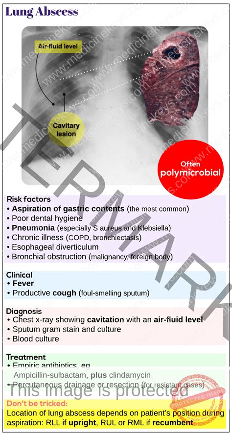 Lung abscess - Medicine Keys for MRCPs