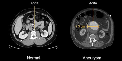 Abdominal CT: aortic aneurysm • LITFL • Radiology Library