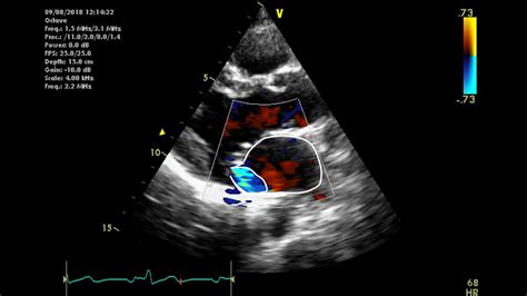 Mitral Valve Echocardiography