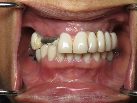 Broken All On 4 Dental Implant Bridges