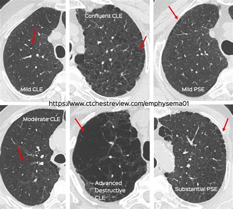 Snippet 12: Visual Classification of Centrilobular and Paraseptal Emphysema