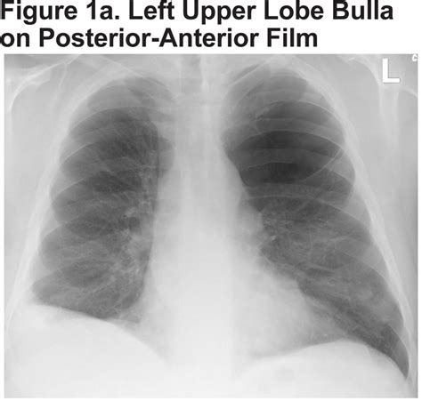 Chest X Ray Emphysema Findings