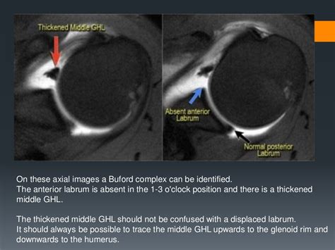 Shoulder labral tears MRI