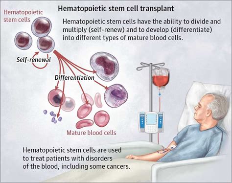 In news: Hematopoietic Stem Cell Transplantations (HSCT)