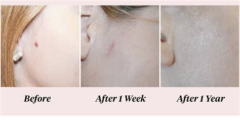 Dermatofibroma Removal Before After