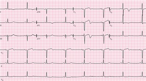 Wellens' syndrome - wikidoc