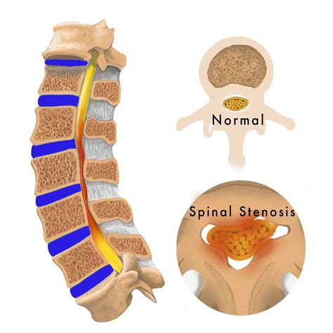 Spinal Stenosis