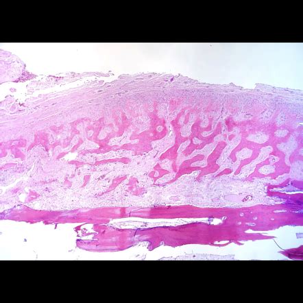 Involucrum (histology) | Radiology Case | Radiopaedia.org