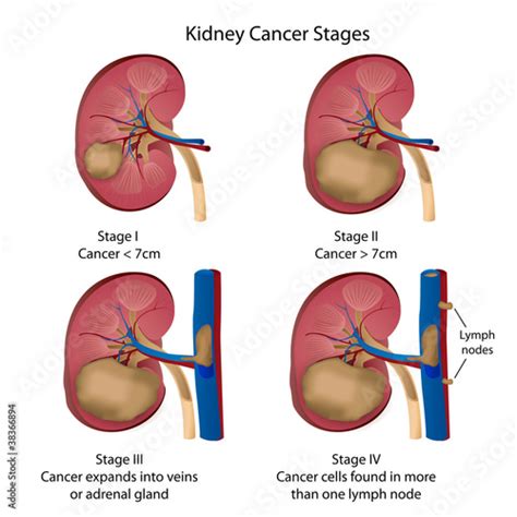 kidney cancer stages vector illustration Stock Vector | Adobe Stock