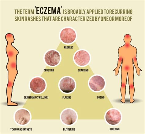 Brief Guidance on Different Types of Eczematous Dermatitis - Basic Baby ...