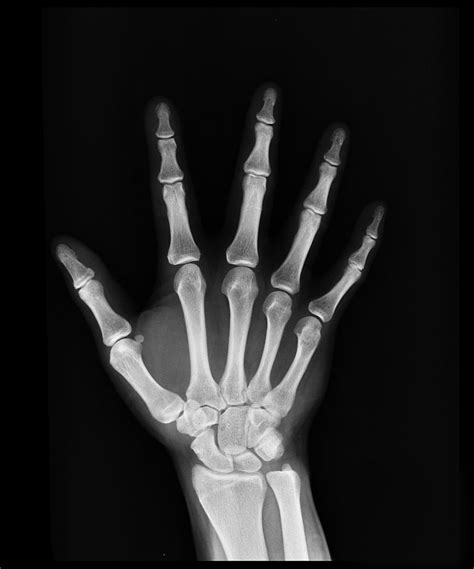 Hand X-Ray