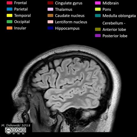 Brain lobes - annotated MRI (Radiopaedia 61691-69700 Sagittal) - NC Commons