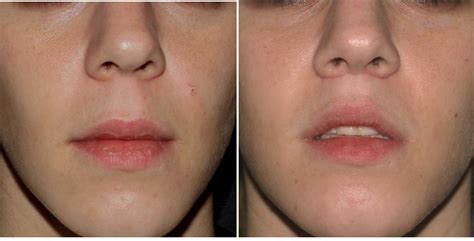 File:Lip Lift Before & After.JPG - Wikipedia