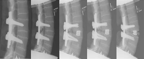 Lateral radiograms of successive steps of testing procedure: from left ...