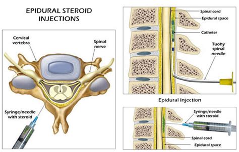 Lumbar Epidural Injection for Back Pain in NYC | Injections for Back Pain