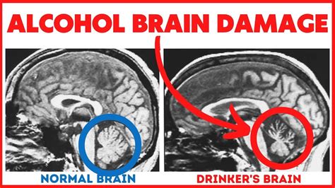 11 Ways Alcohol Induces Brain Damage - Often Irreversible! - Alcohol ...