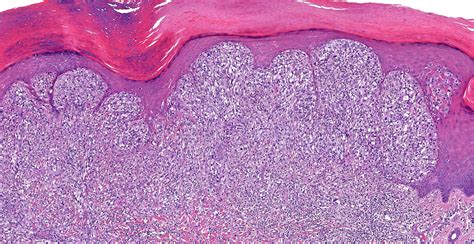 Acral Lentiginous Melanoma Histology