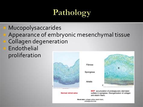 Cardiology - Myxomatous Mitral Valve Degeneration: What's New? By Rit…