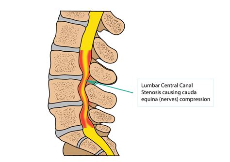 Spinal Stenosis | Dr Yu Chao Lee