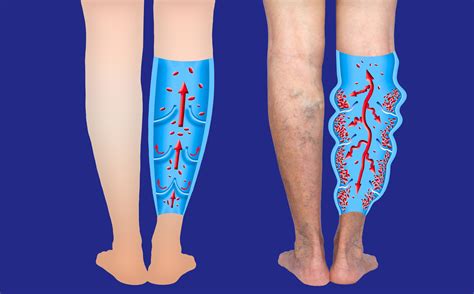 Varicose Veins Diagram - St Louis Laser Veins