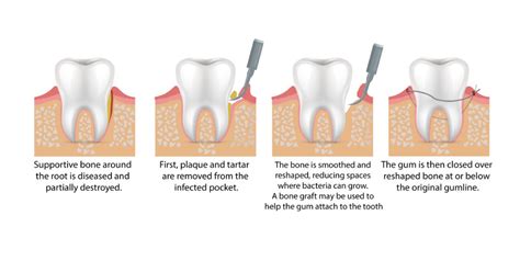 Focus Dental | Flap Surgery for Gums in Hyderabad