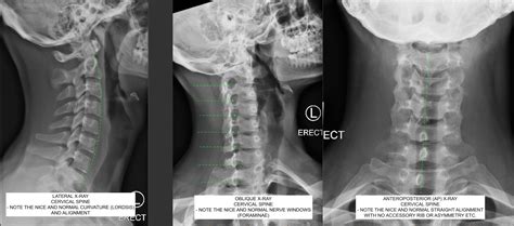 Normal Cervical Spine X-ray | C.N.S. Neurosurgery