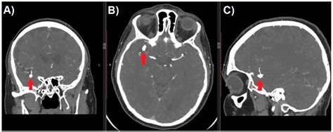 Cerebral Aneurysm Angiogram