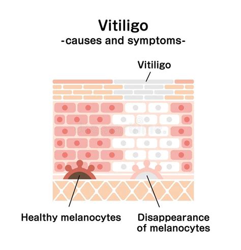 Causes and Symptoms of Vitiligo Vector Illustration Stock Vector ...