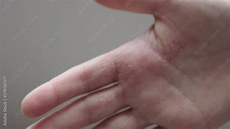 Atopic Dermatitis On Hands Dry Itchy Inflamed Skin Flare Irritations On