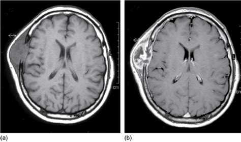 Gadolinium Mri