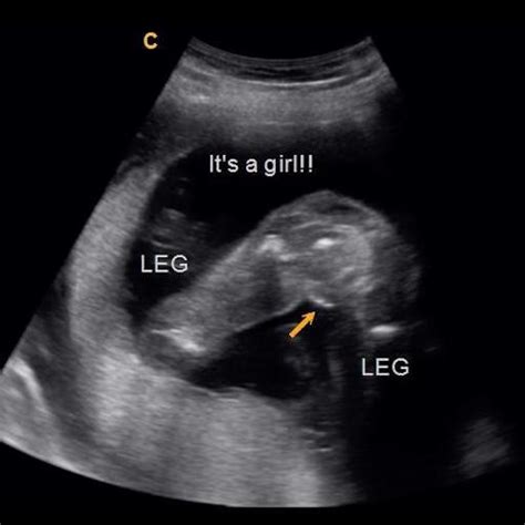 15 Weeks Pregnant Ultrasound Gender