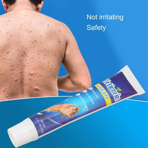 Itching Cream Urticaria Pruritus Ointment for Dry Skin Adjunctive ...