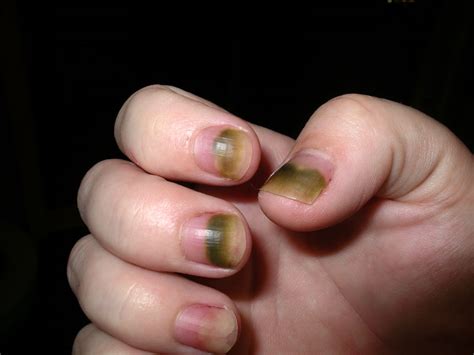 Nails Lifting From Nail Bed After Chemo - Nail Ftempo